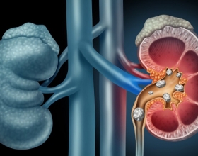  Mổ sỏi thận có nguy hiểm không? Khi nào cần mổ sỏi thận?